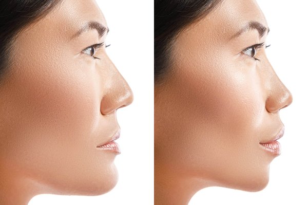 Comment évolue l'oedème après une rhinoplastie ?